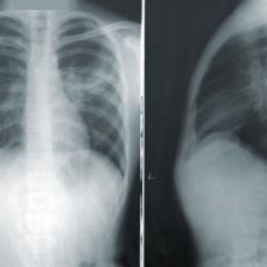 Lung cancer